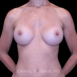 Breast Augmentation Before & After Patient #9328