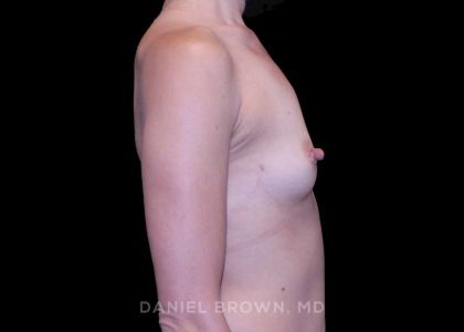 Breast Augmentation Before & After Patient #9328
