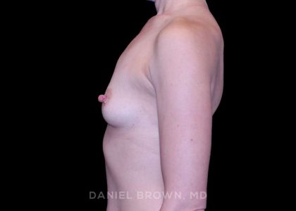 Breast Augmentation Before & After Patient #9328