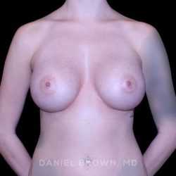 Breast Augmentation Before & After Patient #9350