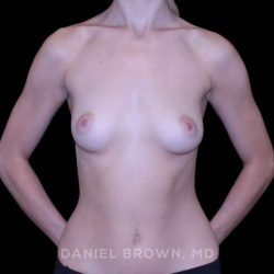 Breast Augmentation Before & After Patient #9372