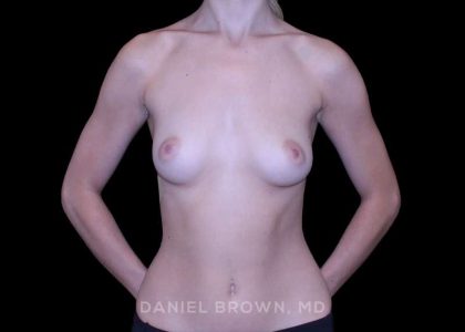 Breast Augmentation Before & After Patient #9372