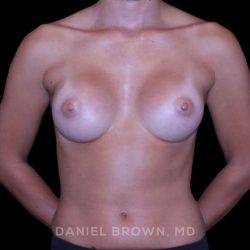 Breast Augmentation Before & After Patient #9383