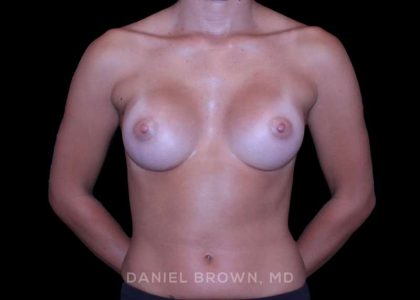 Breast Augmentation Before & After Patient #9383