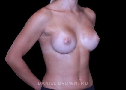 Breast Augmentation Before & After Patient #9383