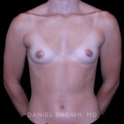 Breast Augmentation Before & After Patient #9383