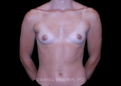 Breast Augmentation Before & After Patient #9383