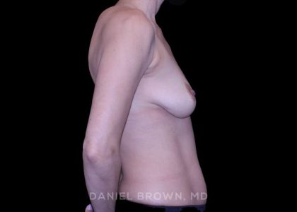 Breast Augmentation Before & After Patient #9394