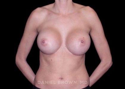 Breast Augmentation Before & After Patient #9405