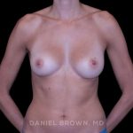 Breast Augmentation Before & After Patient #9405