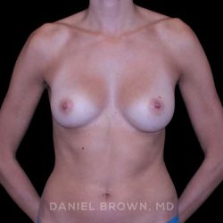 Breast Augmentation Before & After Patient #9405
