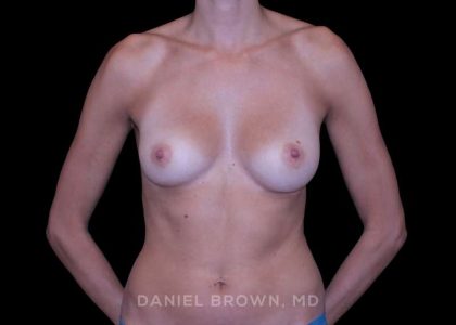 Breast Augmentation Before & After Patient #9405