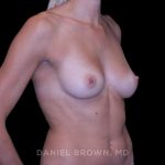 Breast Augmentation Before & After Patient #9405