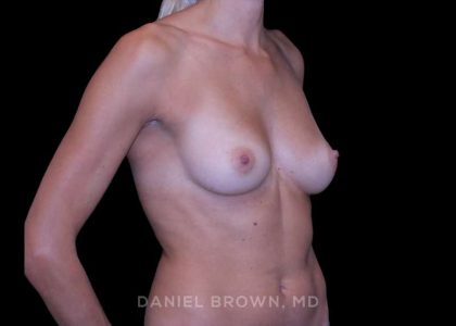 Breast Augmentation Before & After Patient #9405