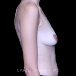 Breast Augmentation Before & After Patient #9416