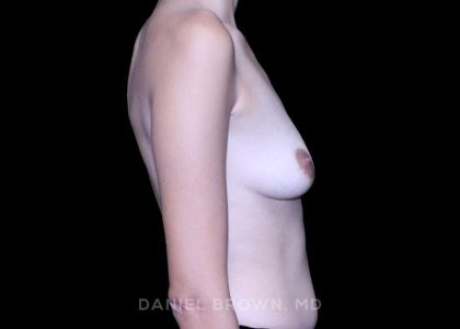 Breast Augmentation Before & After Patient #9416