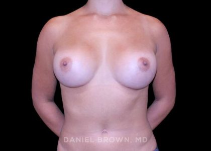 Breast Augmentation Before & After Patient #9427