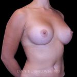Breast Augmentation Before & After Patient #9427