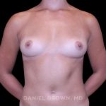Breast Augmentation Before & After Patient #9427