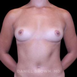 Breast Augmentation Before & After Patient #9427