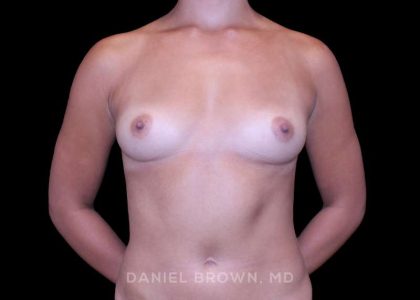 Breast Augmentation Before & After Patient #9427