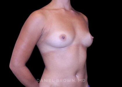 Breast Augmentation Before & After Patient #9427