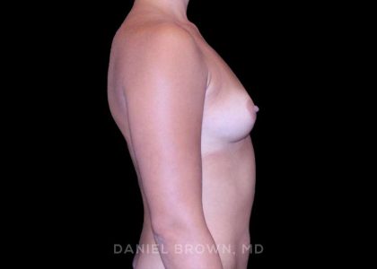 Breast Augmentation Before & After Patient #9427