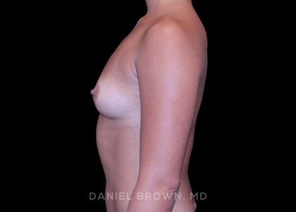 Breast Augmentation Before & After Patient #9427