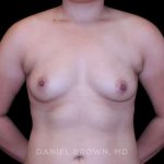Breast Augmentation Before & After Patient #9449