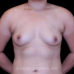 Breast Augmentation Before & After Patient #9449