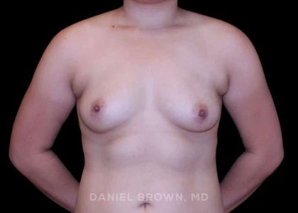 Breast Augmentation Before & After Patient #9449