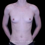 Breast Augmentation Before & After Patient #9460