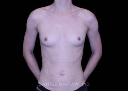 Breast Augmentation Before & After Patient #9460