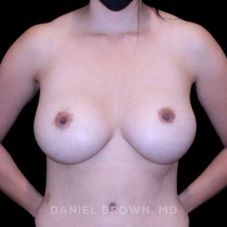 Breast Augmentation Before & After Patient #9471