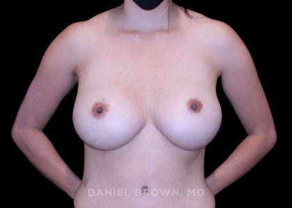 Breast Augmentation Before & After Patient #9471