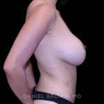 Breast Augmentation Before & After Patient #9471