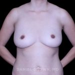 Breast Augmentation Before & After Patient #9471