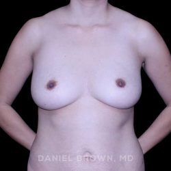 Breast Augmentation Before & After Patient #9471