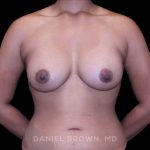 Breast Augmentation Before & After Patient #9482