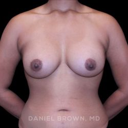 Breast Augmentation Before & After Patient #9482