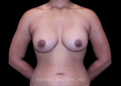 Breast Augmentation Before & After Patient #9482