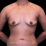 Breast Augmentation Before & After Patient #9482