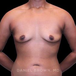 Breast Augmentation Before & After Patient #9482