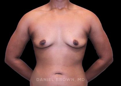 Breast Augmentation Before & After Patient #9482