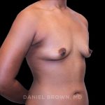 Breast Augmentation Before & After Patient #9482