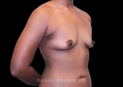 Breast Augmentation Before & After Patient #9482
