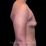 Breast Augmentation Before & After Patient #9482