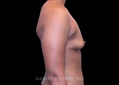 Breast Augmentation Before & After Patient #9482