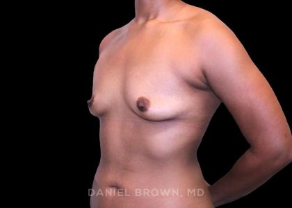 Breast Augmentation Before & After Patient #9482