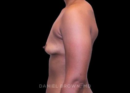 Breast Augmentation Before & After Patient #9482